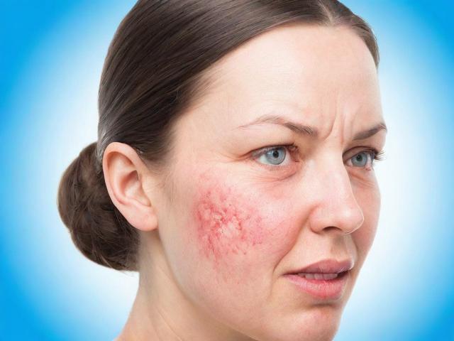 湿疹反复发作？这3个关键点你做到了吗？