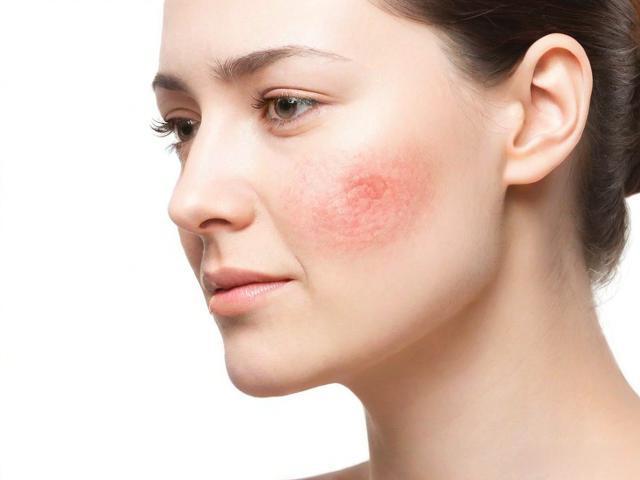 如何区分湿疹和痱子?3点教你轻松分辨并正确治疗!