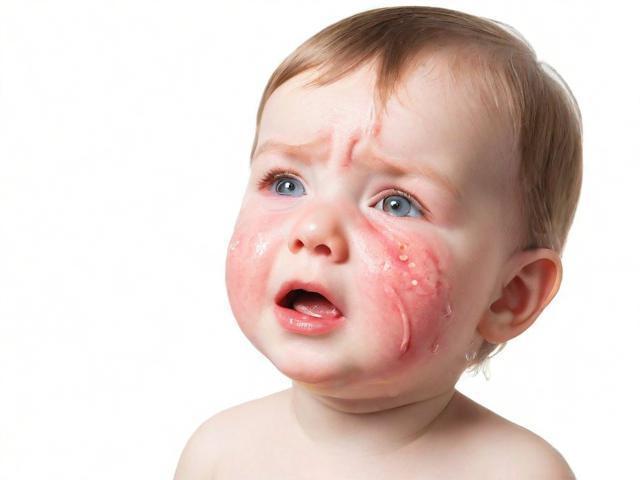 湿疹和热疹的区别：如何正确区分并避免孩子出汗？