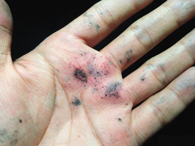 手掌上的色素痣，左右不对称且有毛刺，需手术切除！