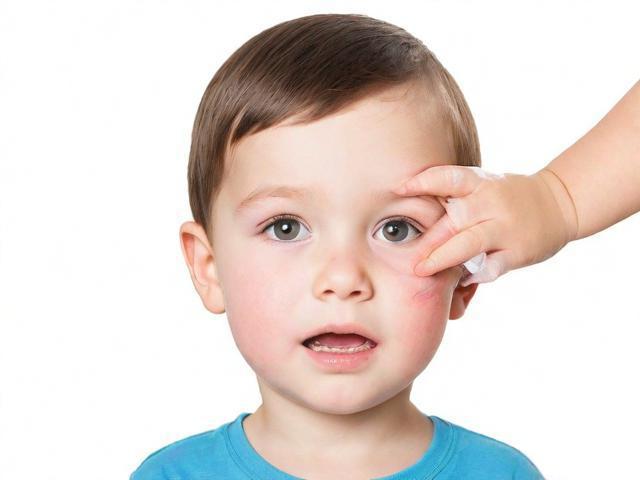 孩子不留疤的3个关键点：清洁、消毒、透气预防留疤