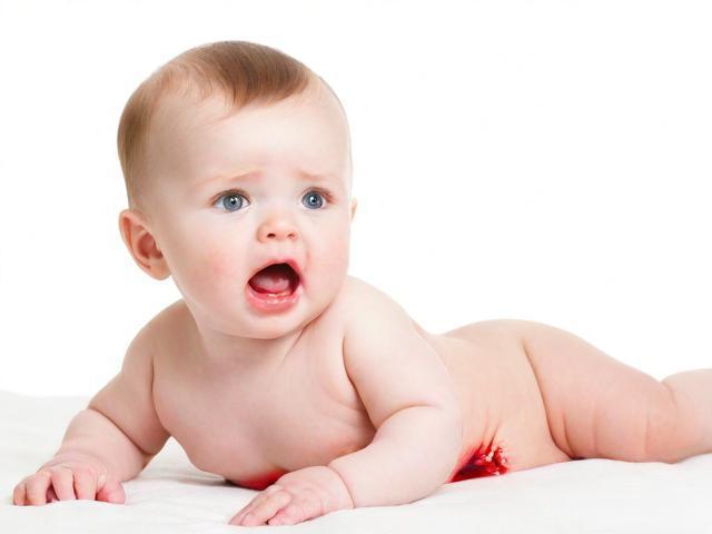 婴儿肛裂与过敏血便如何区分？